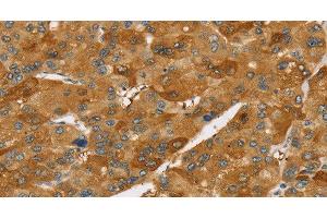 Immunohistochemistry of paraffin-embedded Human liver cancer using TNFSF15 Polyclonal Antibody at dilution of 1:40 (TNFSF15 antibody)