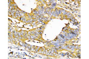 Anti-Caspase-1(P20) antibody, IHC(P) IHC(P): Human Mammary Cancer Tissue (Caspase 1 antibody  (N-Term))