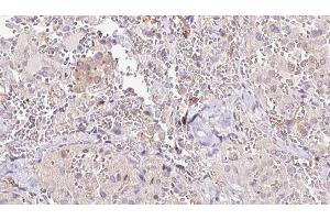 ABIN6273310 at 1/100 staining Human thyroid cancer tissue by IHC-P. (RLBP1 antibody  (Internal Region))