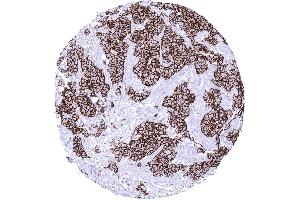 Breast Breast cancer of no special type NST HER2 (Recombinant ErbB2/Her2 antibody  (Extracellular Domain))