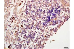 Formalin-fixed and paraffin embedded human lung carcinoma labeled with Anti-IGF2R Polyclonal Antibody, Unconjugated (ABIN719711) at 1:200 followed by conjugation to the secondary antibody and DAB staining (IGF2R antibody  (AA 2201-2400))