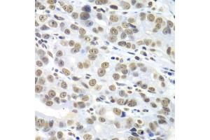 Immunohistochemistry of paraffin-embedded human gastric cancer using HDAC2 antibody (ABIN5971110) at dilution of 1/100 (40x lens).