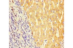 Immunohistochemistry of paraffin-embedded human liver cancer using ABIN7154056 at dilution of 1:100 (GCDH antibody  (AA 45-300))