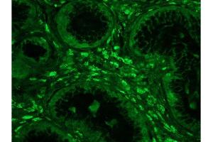 Formalin-fixed and paraffin embedded human colon carcinoma tissue labeled with Anti-Phospho-IKK alpha/beta (Ser176/Ser180) Polyclonal Antibody, Unconjugated  at 1:200 followed by conjugation to the secondary antibody, Goat Anti-Rabbit IgG, FITC conjugated-FITC). (IKK-alpha /IKK-beta antibody  (pSer176, pSer180))
