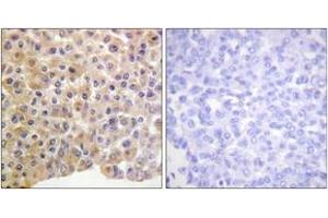 Immunohistochemistry analysis of paraffin-embedded human breast carcinoma, using IR (Phospho-Tyr1361) Antibody. (IR (AA 1331-1380), (pTyr1361) antibody)