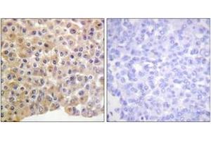 Immunohistochemistry analysis of paraffin-embedded human breast carcinoma, using IR (Phospho-Tyr1361) Antibody. (IR (AA 1331-1380), (pTyr1361) antibody)