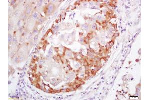 Formalin-fixed and paraffin embedded human lung cancer labeled with Rabbit Anti-S100A4 Polyclonal Antibody, Unconjugated 1:200 followed by conjugation to the secondary antibody and DAB staining (s100a4 antibody  (AA 15-101))