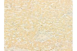 ABIN6265028 and ABIN6279790 at 1/100 staining human hepatocellular carcinoma by IHC-P.