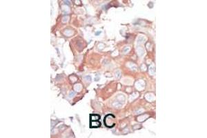 Formalin-fixed and paraffin-embedded human cancer tissue reacted with the primary antibody, which was peroxidase-conjugated to the secondary antibody, followed by AEC staining. (MAP3K1 antibody  (C-Term))