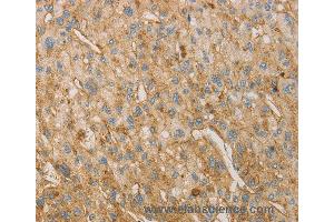 Immunohistochemistry of Human liver cancer using VTN Polyclonal Antibody at dilution of 1:40