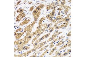 Immunohistochemistry of paraffin-embedded human liver cancer using HAPLN1 antibody (ABIN5973979) at dilution of 1/100 (40x lens).