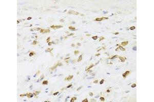 Immunohistochemistry of paraffin-embedded Human gastric cancer using LSP1 Polyclonal Antibody at dilution of 1:100 (40x lens). (LSP1 antibody)
