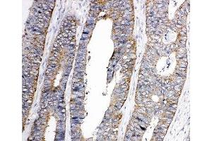 IHC-P: EphA1 antibody testing of human colon cancer tissue (EPHA1 antibody  (C-Term))