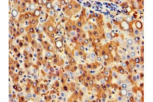 IHC image of ABIN7154972 diluted at 1:300 and staining in paraffin-embedded human liver cancer performed on a Leica BondTM system. (Hemoglobin Subunit beta antibody  (AA 1-147))