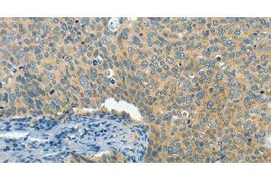 Immunohistochemistry of paraffin-embedded Human cervical cancer tissue using BCAT1 Polyclonal Antibody at dilution 1:50 (BCAT1 antibody)