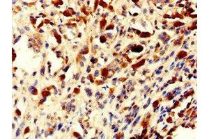 Immunohistochemistry of paraffin-embedded human melanoma using ABIN7154802 at dilution of 1:100 (NHP2 antibody  (AA 1-153))