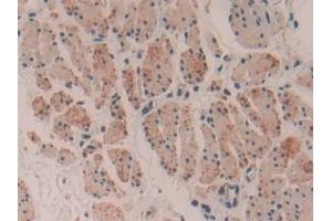 Detection of MYH16 in Human Esophagus cancer Tissue using Polyclonal Antibody to Myosin Heavy Chain 16 (MYH16) (MYH16 antibody  (AA 209-469))