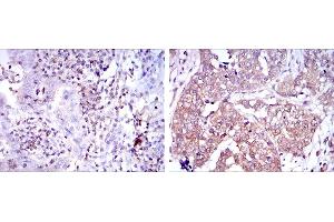Immunohistochemical analysis of paraffin-embedded human intima cancer tissues (left) and human bladder cancer tissues (right) using NFKB1 mouse mAb with DAB staining.