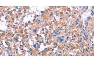 Immunohistochemistry of paraffin-embedded Human thyroid cancer tissue using ELP2 Polyclonal Antibody at dilution 1:40