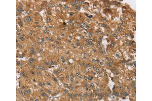 Immunohistochemistry of Human colon cancer using RPS6KA2 Polyclonal Antibody at dilution of 1:40