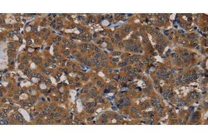 Immunohistochemistry of paraffin-embedded Human thyroid cancer tissue using PDE5A Polyclonal Antibody at dilution 1:50