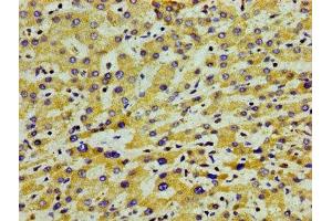 Immunohistochemistry of paraffin-embedded human liver cancer using ABIN7144407 at dilution of 1:100 (APOA5 antibody  (AA 260-366))