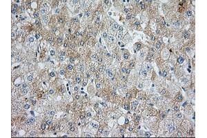 Immunohistochemical staining of paraffin-embedded Human liver tissue using anti-BIRC5 mouse monoclonal antibody. (Survivin antibody)
