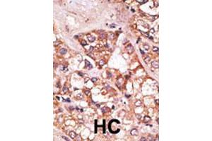 Formalin-fixed and paraffin-embedded human hepatocellular carcinoma tissue reacted with the BIK polyclonal antibody  , which was peroxidase-conjugated to the secondary antibody, followed by AEC staining. (BIK antibody  (N-Term))