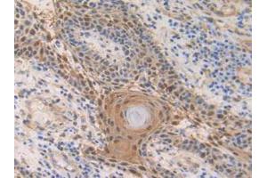 IHC-P analysis of Human Skin Cancer Tissue, with DAB staining. (S100A2 antibody  (AA 2-98))
