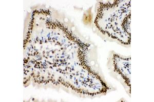 Immunohistochemistry (Paraffin-embedded Sections) (IHC (p)) image for anti-Hypoxia Inducible Factor 1, alpha Subunit (Basic Helix-Loop-Helix Transcription Factor) (HIF1A) (AA 703-732), (C-Term) antibody (ABIN3043841) (HIF1A antibody  (C-Term))