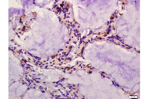 Formalin-fixed and paraffin embedded human colon carcinoma labeled with Anti-CD162 Polyclonal Antibody, Unconjugated (ABIN679298) at 1:200 followed by conjugation to the secondary antibody and DAB staining (SELPLG antibody  (AA 251-350))