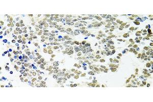 Immunohistochemistry of paraffin-embedded Human lung cancer using PPP4C Polyclonal Antibody at dilution of 1:100 (40x lens). (PPP4C antibody)