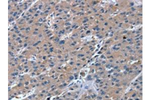 The image on the left is immunohistochemistry of paraffin-embedded Human liver cancer tissue using ABIN7130871(RGS11 Antibody) at dilution 1/20, on the right is treated with fusion protein.