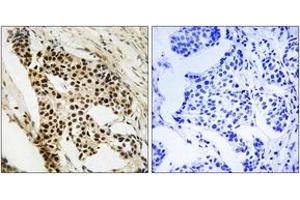 Immunohistochemistry analysis of paraffin-embedded human breast carcinoma tissue, using MAPKAPK2 (Ab-272) Antibody. (MAPKAP Kinase 2 antibody  (AA 238-287))