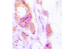 Immunohistochemical analysis of Cytokeratin 19 staining in human lung cancer formalin fixed paraffin embedded tissue section. (Cytokeratin 19 antibody  (C-Term))