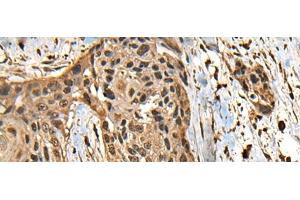 Immunohistochemistry of paraffin-embedded Human esophagus cancer tissue using CCDC113 Polyclonal Antibody at dilution of 1:65(x200) (CCDC113 antibody)