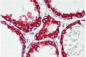 Human Thyroid (formalin-fixed, paraffin-embedded) stained with P4HB antibody ABIN396933 at 5 ug/ml followed by biotinylated anti-mouse IgG secondary antibody ABIN481714, alkaline phosphatase-streptavidin and chromogen. (P4HB antibody  (AA 499-509))