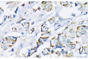 Immunohistochemistry of paraffin-embedded Human breast cancer using HK2 Polyclonal Antibody at dilution of 1:200 (40x lens). (Hexokinase 2 antibody)