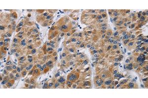 Immunohistochemistry of paraffin-embedded Human liver cancer using IFNGR2 Polyclonal Antibody at dilution of 1:40 (IFNGR2 antibody)