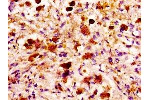 IHC image of ABIN7158974 diluted at 1:100 and staining in paraffin-embedded human melanoma performed on a Leica BondTM system. (MASP2 antibody  (AA 189-314))