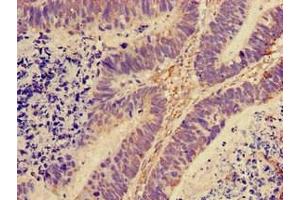 Immunohistochemistry of paraffin-embedded human ovarian cancer using ABIN7142793 at dilution of 1:100