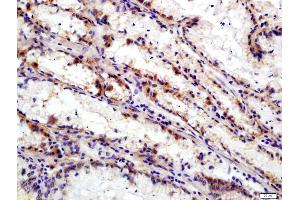 Formalin-fixed and paraffin embedded human gastric carcinoma labeled with Anti-Integrin Alpha V + Beta 6 Polyclonal Antibody, Unconjugated (ABIN714806) at 1:200 followed by conjugation to the secondary antibody and DAB staining (ITGAV/ITGB6 antibody)