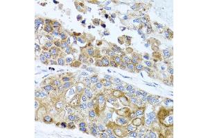 Immunohistochemistry of paraffin-embedded human lung cancer using PEX14 antibody (ABIN5975501) at dilution of 1/100 (40x lens).