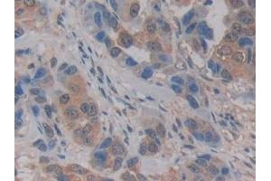 Immunohistochemistry (IHC) image for anti-Kallikrein 2 (KLK2) (AA 19-261) antibody (ABIN7435352)