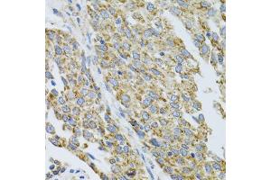 Immunohistochemistry of paraffin-embedded human lung cancer using CYP1A1 antibody (ABIN5971186) at dilution of 1/100 (40x lens). (CYP1A1 antibody)