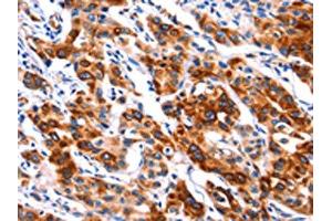 The image on the left is immunohistochemistry of paraffin-embedded Human lung cancer tissue using ABIN7192314(SEPT4 Antibody) at dilution 1/50, on the right is treated with synthetic peptide. (Septin 4 antibody)