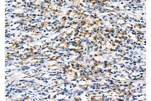 ABIN6262292 and ABIN6276762 at 1/100 staining Human lung cancer by IHC-P.