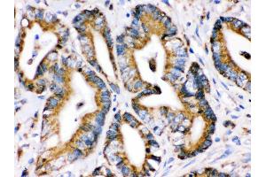 Anti- Grp75 Picoband antibody,IHC(P) IHC(P): Human Intestinal Cancer Tissue (HSPA9 antibody  (C-Term))