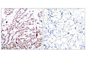 Immunohistochemical analysis of paraffin-embedded human breast carcinoma tissue using ATF2(Phospho-Thr73 or 55) Antibody(left) or the same antibody preincubated with blocking peptide(right). (ATF2 antibody  (pThr73))