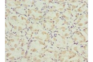 Immunohistochemistry of paraffin-embedded human gastric cancer using ABIN7165131 at dilution of 1:100